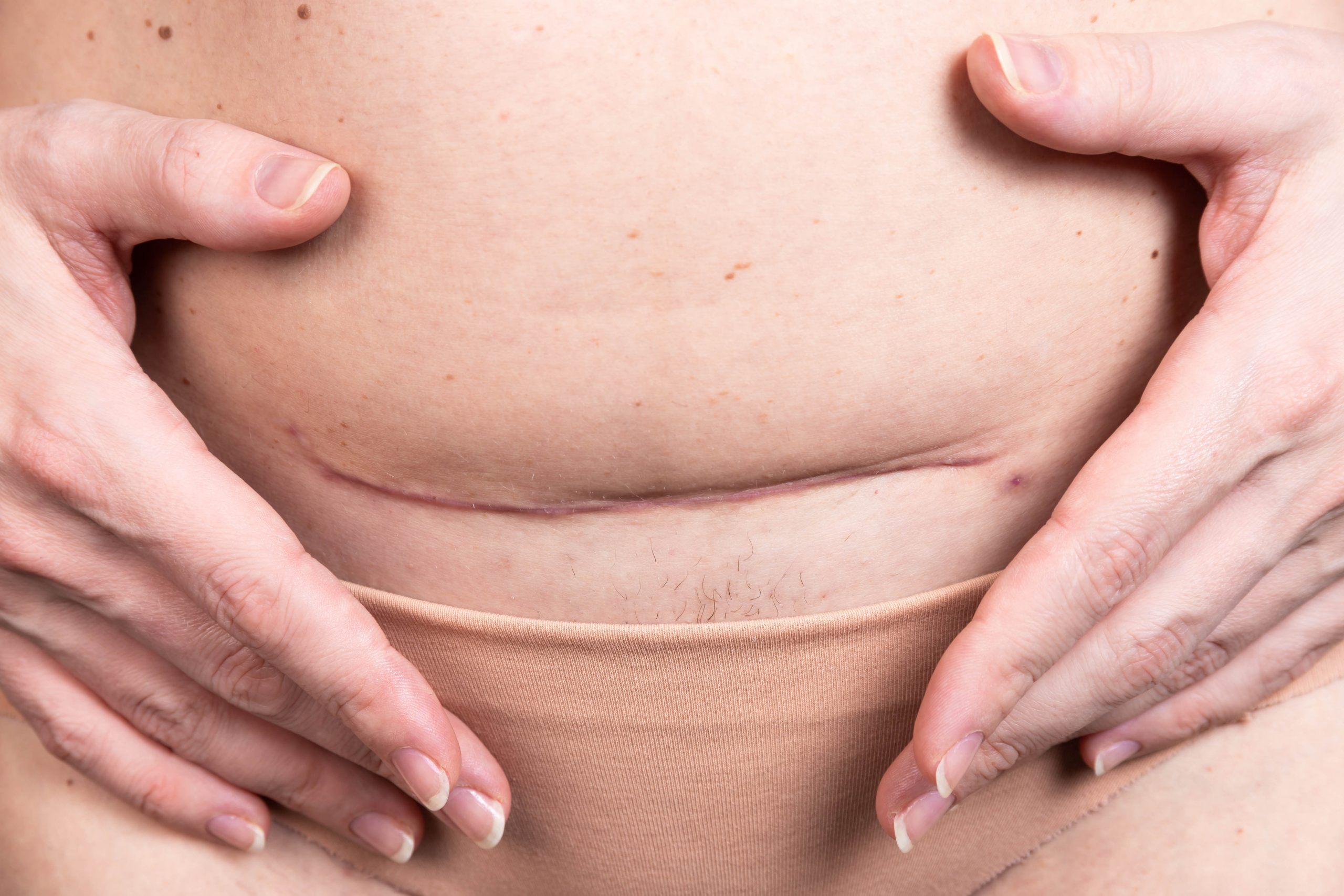Как убрать живот после родов: ТОП-5 эффективных способов