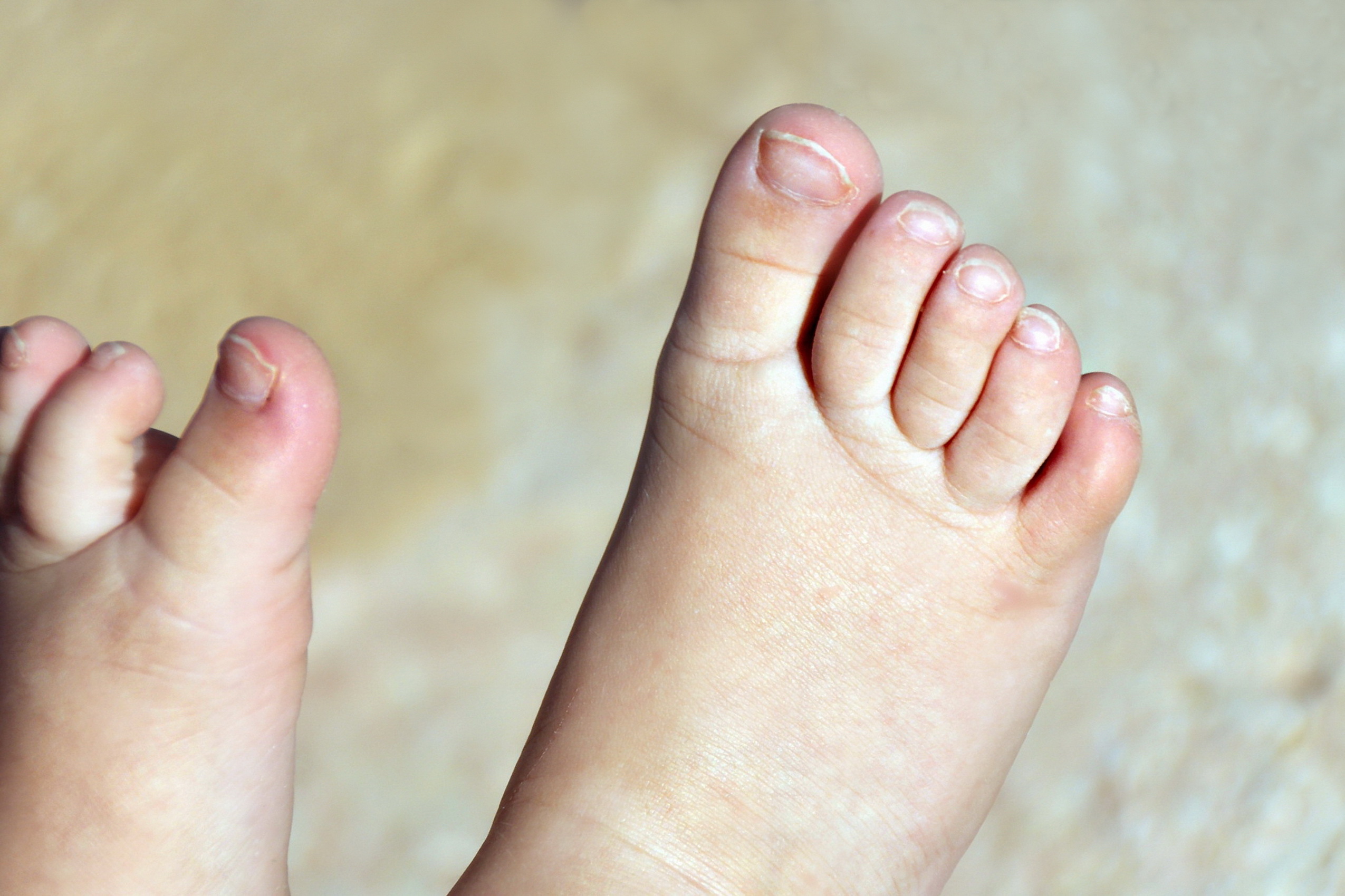 Вросший ноготь на ноге у ребенка: как помочь малышу