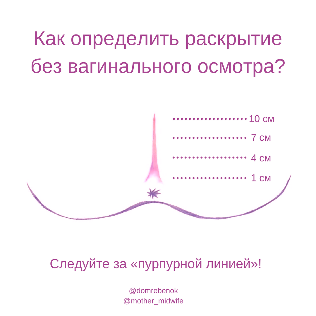 Можно ли раскрывать. Этапы раскрытия шейки матки в родах. Раскрытие шейной матки. Пурпурная линия раскрытие шейки. Пурпурная линия раскрытие шейки матки.