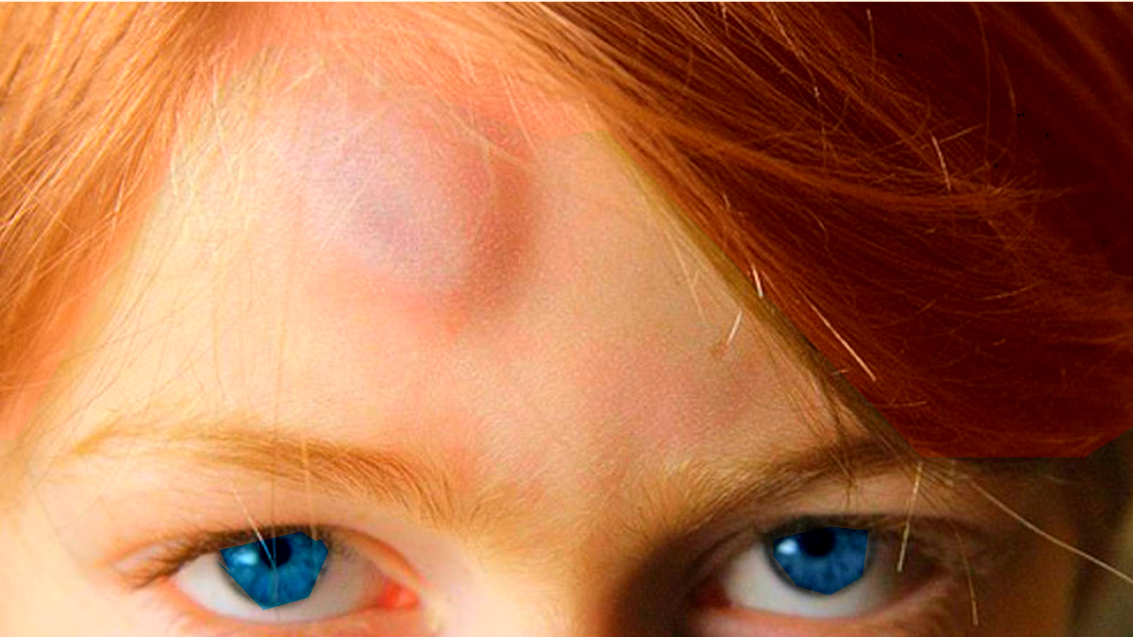 Почему появляется шишка на голове у ребенка без удара