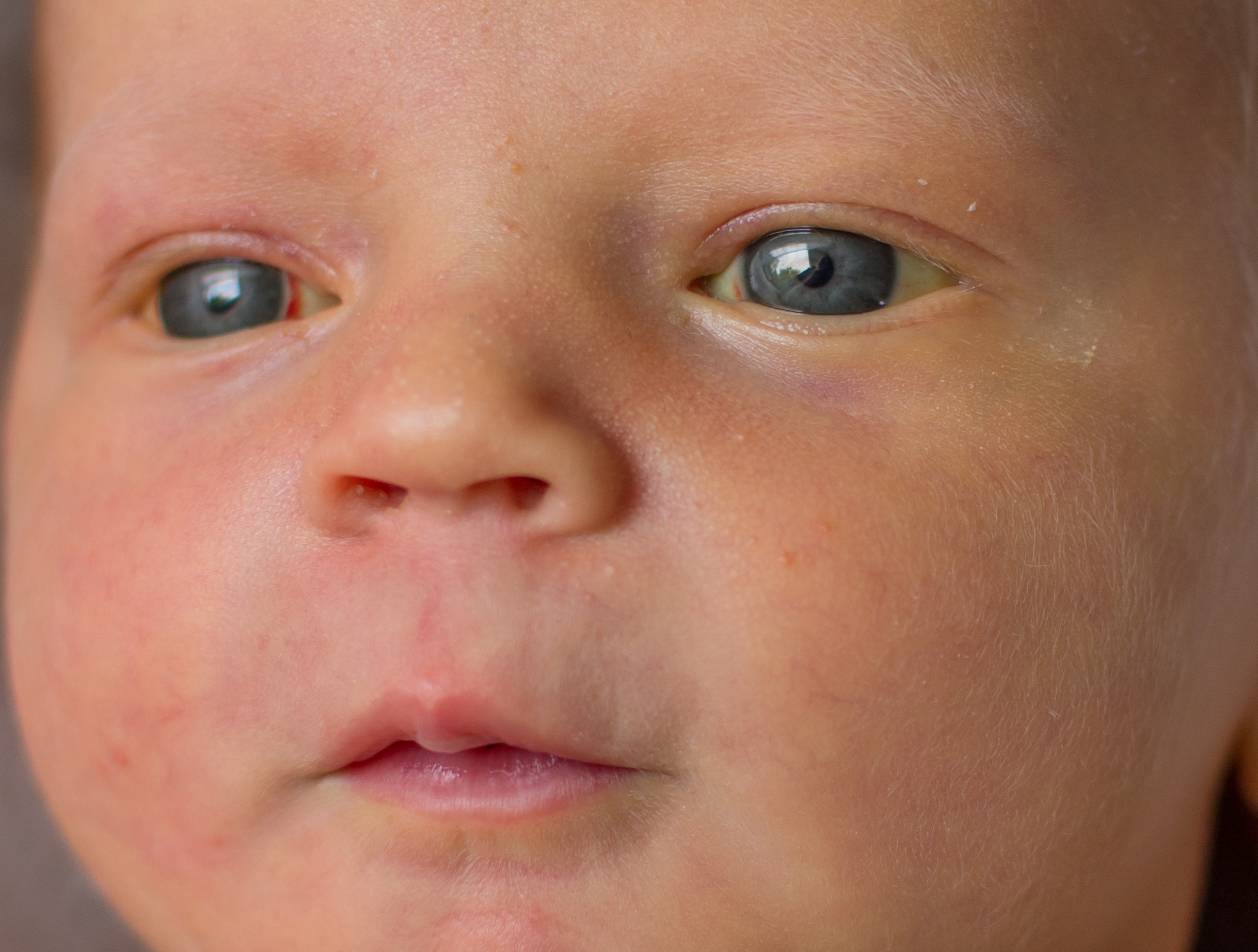 Милии у новорожденных: почему появляются и требуют ли лечения